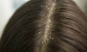 تفسير حلم القمل في المنام ودلالاته المختلفة حسب ابن سيرين