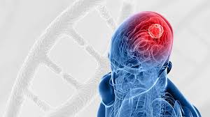  اختراق علمي جديد يفتح باب الأمل لعلاج الورم الأرومي الدبقي أخطر سرطان في الدماغ