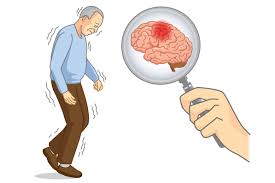 تحليل الشعر وتشخيص باركنسون: هل تكشف خصلة واحدة المرض مبكراً؟