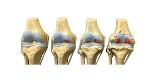 تزايد خشونة المفاصل بين الشباب.. هل أصبح الفصال العظمي مرض العصر؟