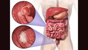 سرطان القولون والمستقيم عند الشباب.. لماذا تتزايد الإصابات وكيف يمكن الوقاية؟