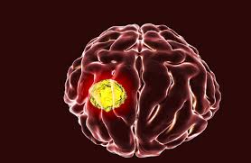  اختراق علمي جديد يفتح باب الأمل لعلاج الورم الأرومي الدبقي أخطر سرطان في الدماغ