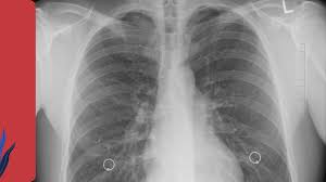 اكتشاف جديد يكشف دور خلايا الرئة السليمة في دعم انتشار السرطان