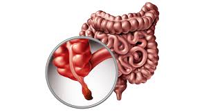 هل الزائدة الدودية عضو عديم الفائدة؟ أبحاث جديدة تكشف دورها الحقيقي