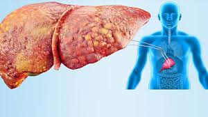 دراسة تحذر علاج محتمل للكبد الدهني قد يزيد خطر سرطان الكبد