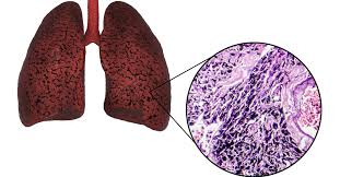 اكتشاف جديد يكشف دور خلايا الرئة السليمة في دعم انتشار السرطان