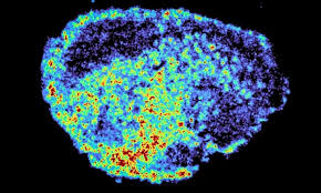 فعالية أدوية السرطان لماذا تنجح لدى البعض وتفشل لدى آخرين؟