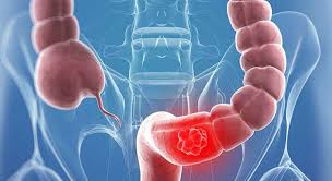 أطعمة تحمي من سرطان القولون: دليل غذائي مدعوم بالأبحاث