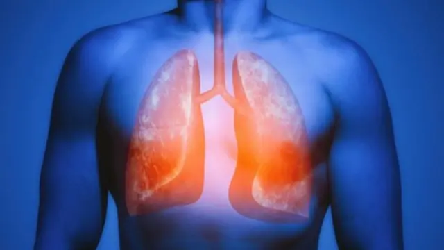 اكتشاف جديد يكشف دور خلايا الرئة السليمة في دعم انتشار السرطان