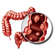 اللحوم المصنعة وسرطان القولون فجوة في الوعي رغم الأدلة العلمية