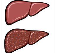 دراسة تحذر علاج محتمل للكبد الدهني قد يزيد خطر سرطان الكبد