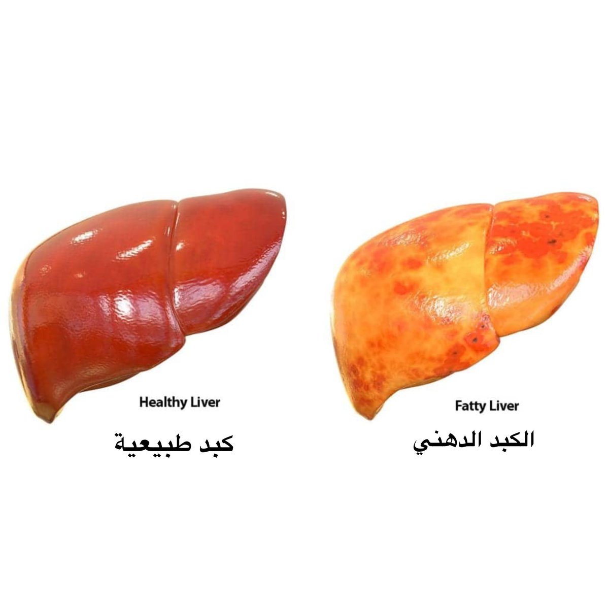 دراسة تحذر علاج محتمل للكبد الدهني قد يزيد خطر سرطان الكبد