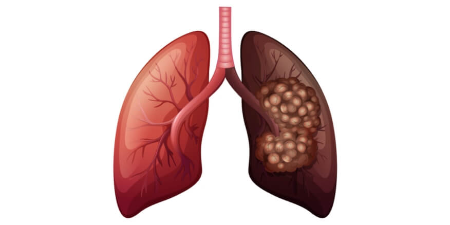 اكتشاف جديد يكشف دور خلايا الرئة السليمة في دعم انتشار السرطان