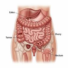 اللحوم المصنعة وسرطان القولون فجوة في الوعي رغم الأدلة العلمية