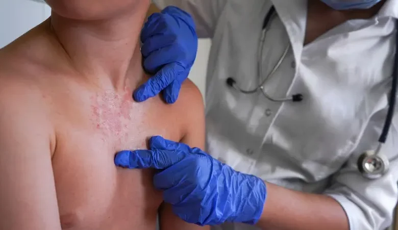 الحمى القرمزية في التاريخ هل وُجدت في الأميركتين قبل وصول الأوروبيين؟