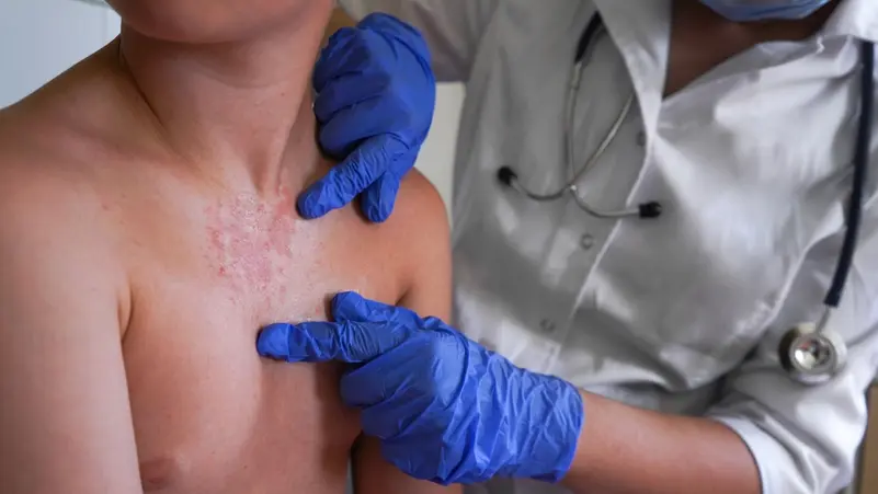 الحمى القرمزية في التاريخ هل وُجدت في الأميركتين قبل وصول الأوروبيين؟