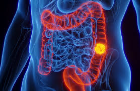 تقدم علمي جديد في العلاج الضوئي الديناميكي للسرطان ينجح في البيئات منخفضة الأكسجين