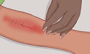 تأثير الوحدة على الصحة هل تبطئ التئام الجروح