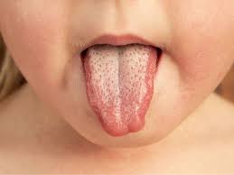 الحمى القرمزية في التاريخ: هل وُجدت في الأميركتين قبل وصول الأوروبيين؟